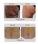 Selenia Italia anticeliulitinis ir senėjimą stabdantis aparatas DERMO SLIM™ - Image 6