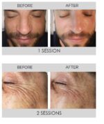 Selenia Italia anticeliulitinis ir senėjimą stabdantis aparatas DERMO SLIM™ - Image 8